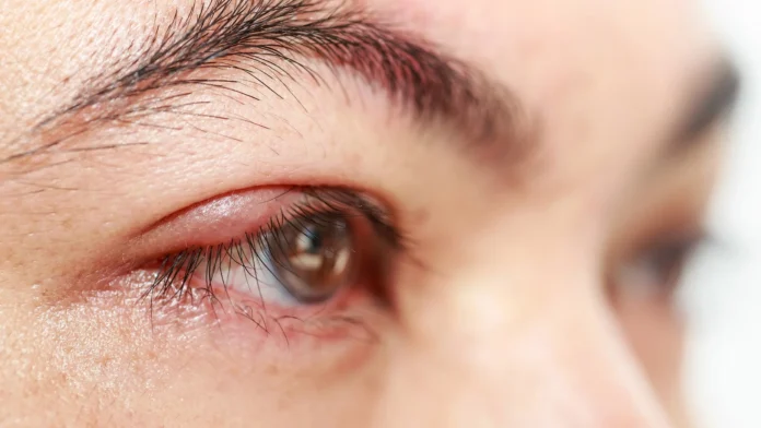 eye stye treatment